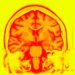 Imagem de ressonância magnética de um cérebro epiléptico. Cientistas testaram um implante cerebral que ajudara a memória em pessoas com epilepsia. (Bsip/UIG)
