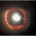 Aspecto flamejante no olho do paciente, causado por rara mutação genética. (Imagem: The New England Journal of Medicine)