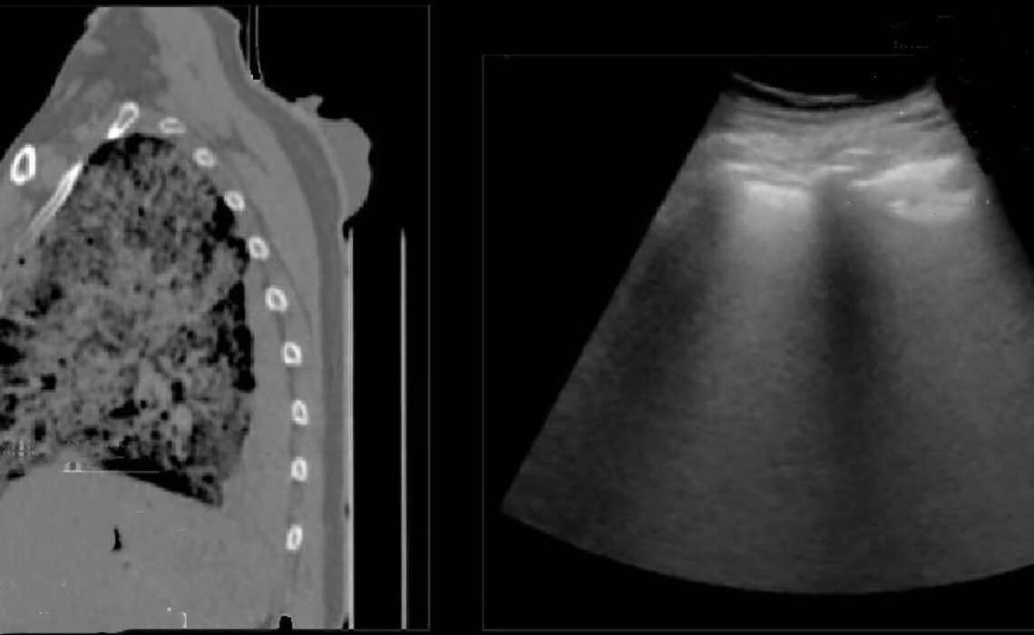 A tomografia computadorizada do tórax mostra sinais de pneumonia viral causada pelo Covid-19. (ramificações esbranquiçadas) (imagem: Departamento de Patologia/FM-USP)