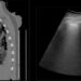 A tomografia computadorizada do tórax mostra sinais de pneumonia viral causada pelo Covid-19. (ramificações esbranquiçadas) (imagem: Departamento de Patologia/FM-USP)