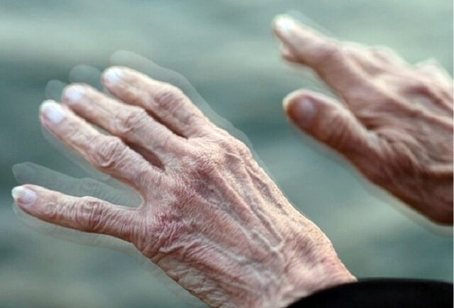 Cientistas conseguiram reverter a doença de Parkinson