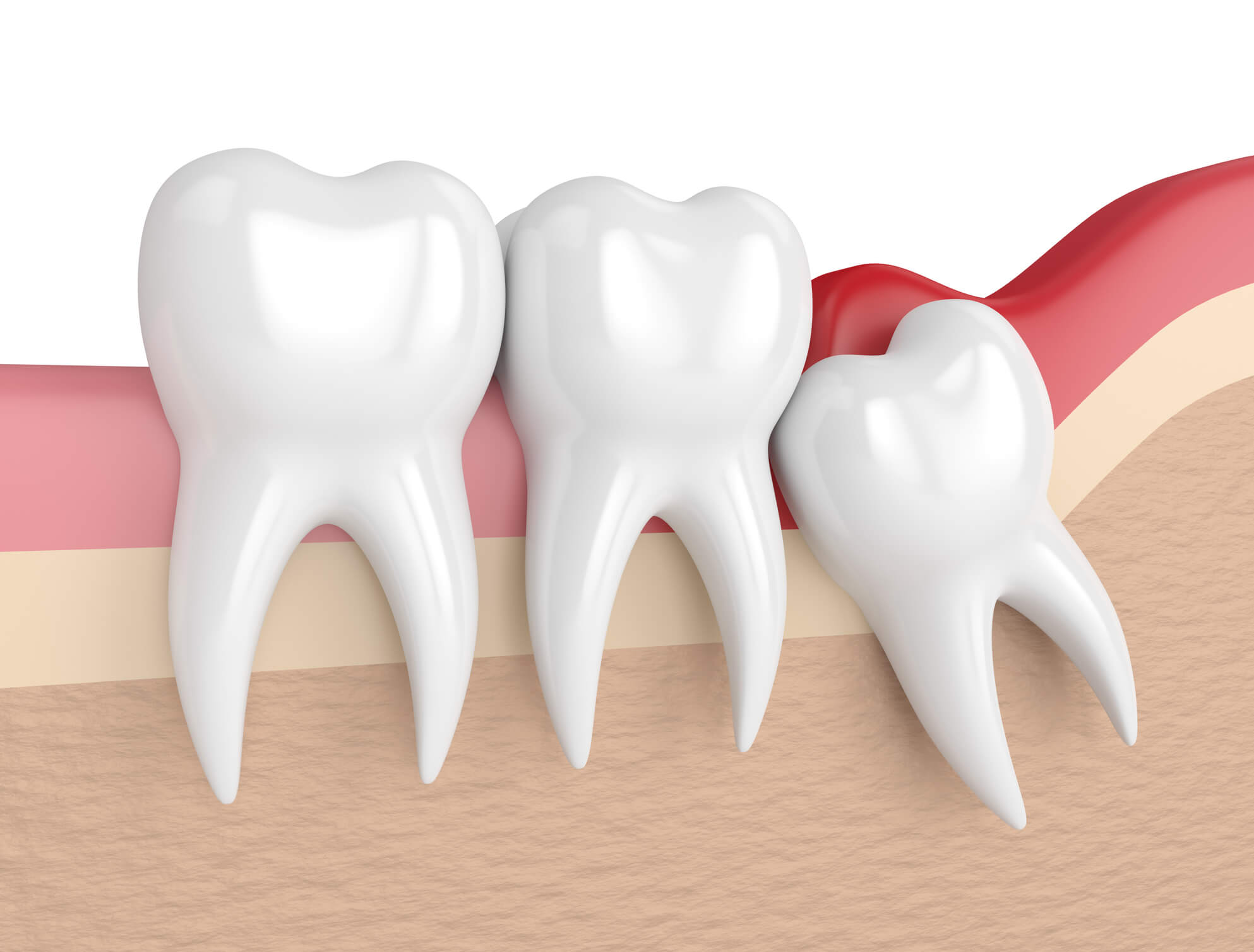 O dente do siso pode simplesmente não se encaixar juntos aos outros molares