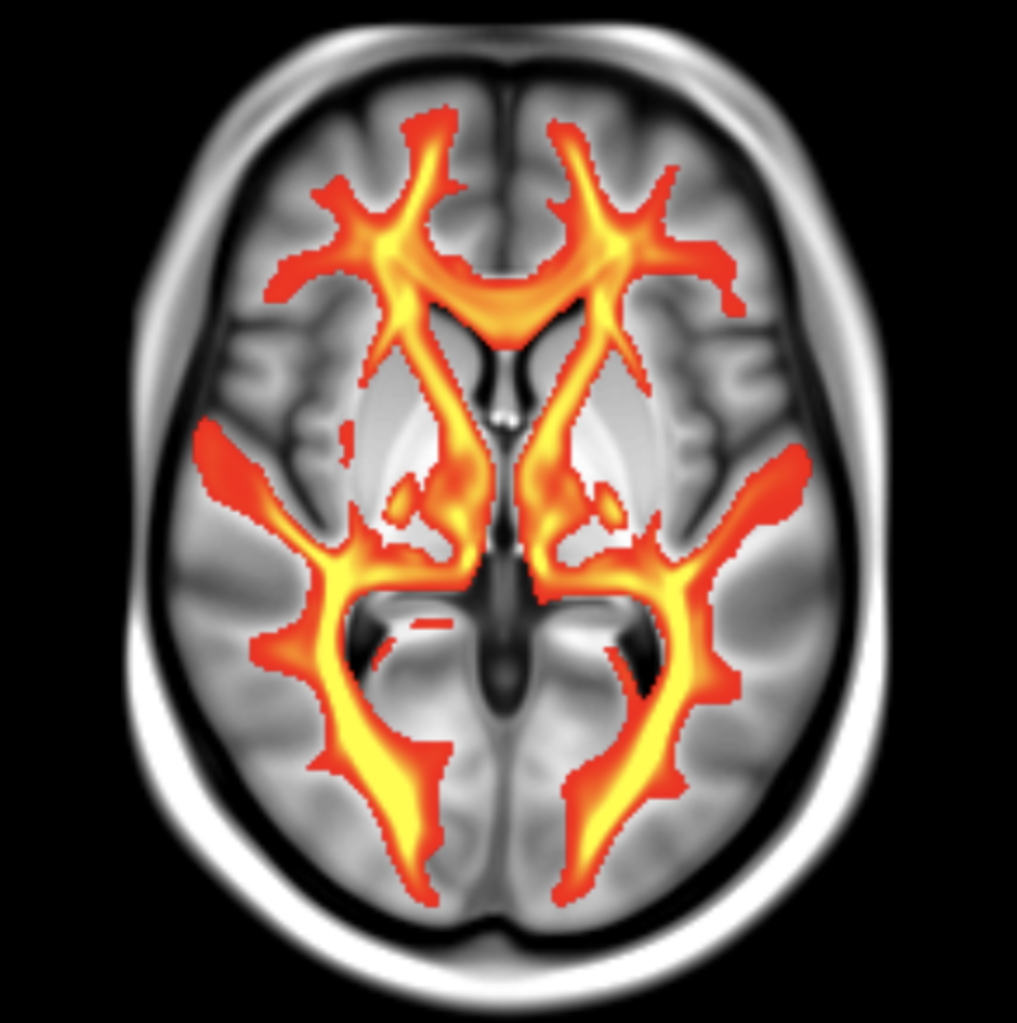 Exame de ressonância magnética do cérebro 