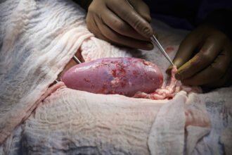 pig kidney human transplant1