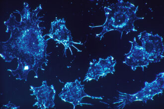 Nesta imagem, podemos observar células cancerígenas em cultura de tecido conjuntivo humano. As células estão sendo iluminadas através de um contraste amplificado de campo escuro, permitindo uma visualização mais detalhada. A ampliação utilizada é de 500x.