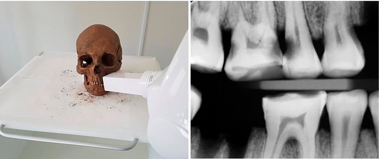 Um orifício limado da coroa do dente até a polpa – um procedimento que reduz a dor de dente e a infecção.