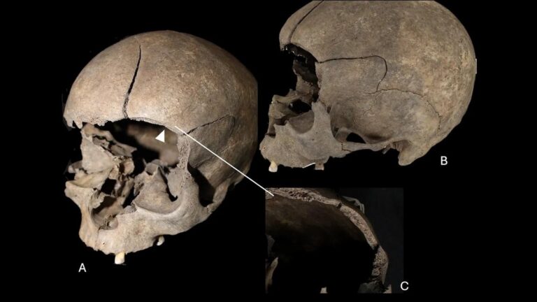 Três vistas de crânio humano sobre fundo preto, com grande fratura visível e detalhe ampliado da borda danificada.
